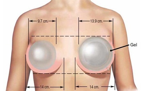 Безліч жінок вирішуються на операцію по збільшенню   грудей,   але далеко не всі усвідомлюють можливі нюанси цієї процедури